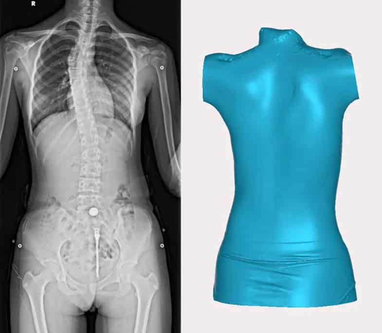 Digitalização 3D para a Ortopedia: Como Pode Ser Útil na Criação de Órteses? 1