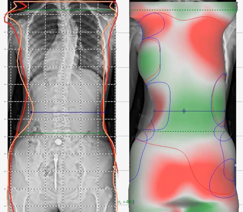 Digitalização 3D para a Ortopedia: Como Pode Ser Útil na Criação de Órteses? 2